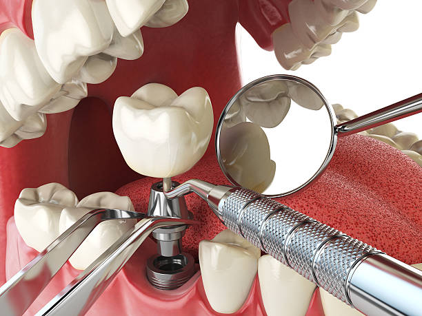 Best Emergency Treatment for Dental Infections or Abscesses in Westlake, TX